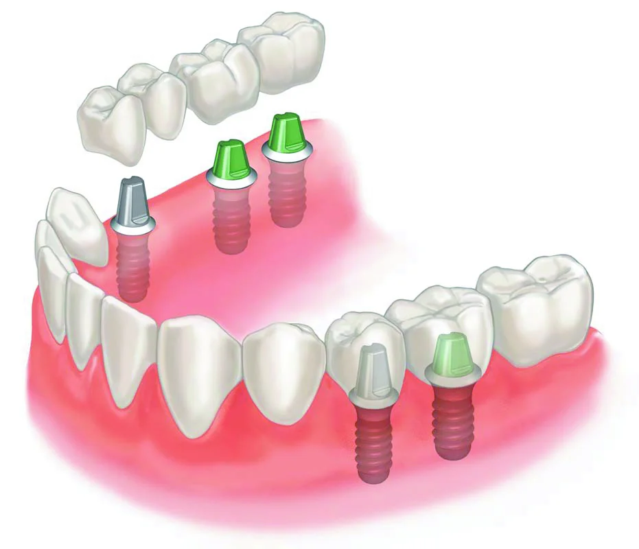 Orthopaedic dentistry – a type of microprosthesis