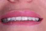 Лазерная коррекция десневой улыбки