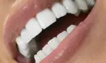 Голливудские виниры