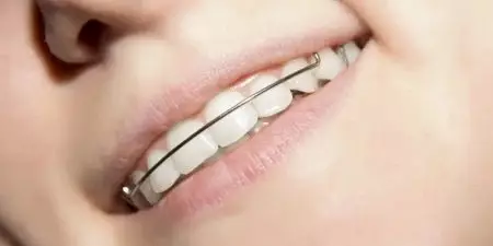 Пластини на зуби