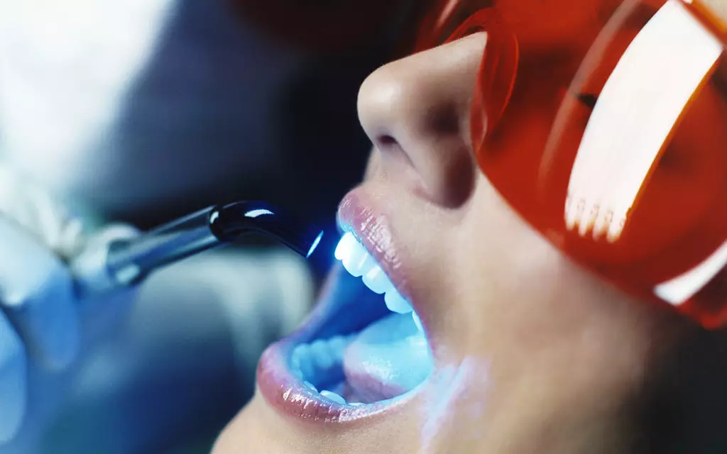 White teeth whitening