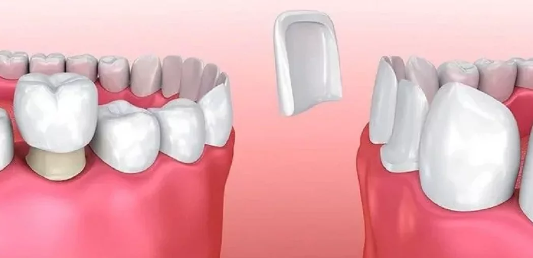 Виниры vs коронки — что подойдет именно вам
