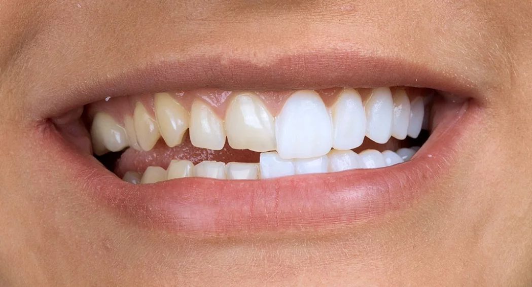 Виниры vs коронки — что подойдет именно вам